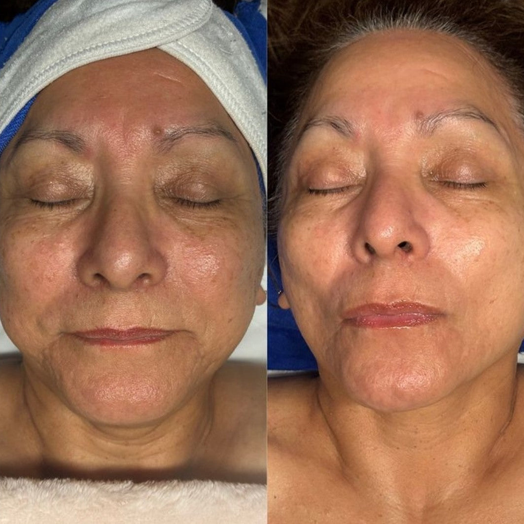 Anti Ageing/Wrinkle/Skin tightening Treatment