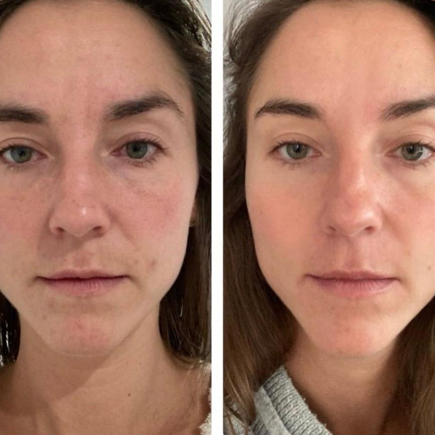 Guasha Facial Rejuvenation with Ancient wisdom