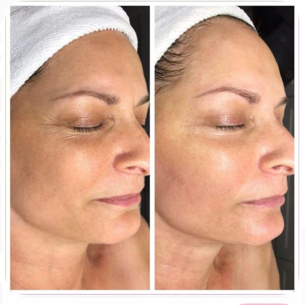 Whitening Lift Treatment