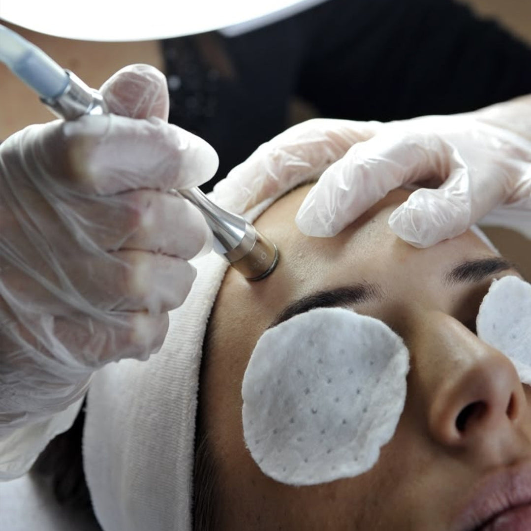 Microdermabrasion Facial