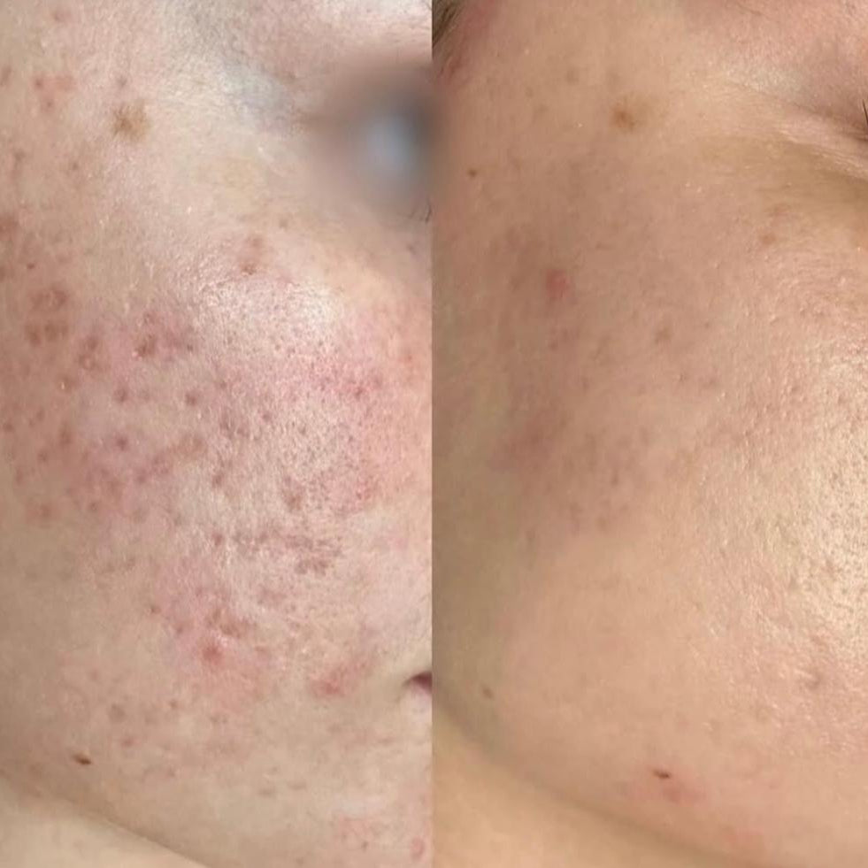 Acne Facial