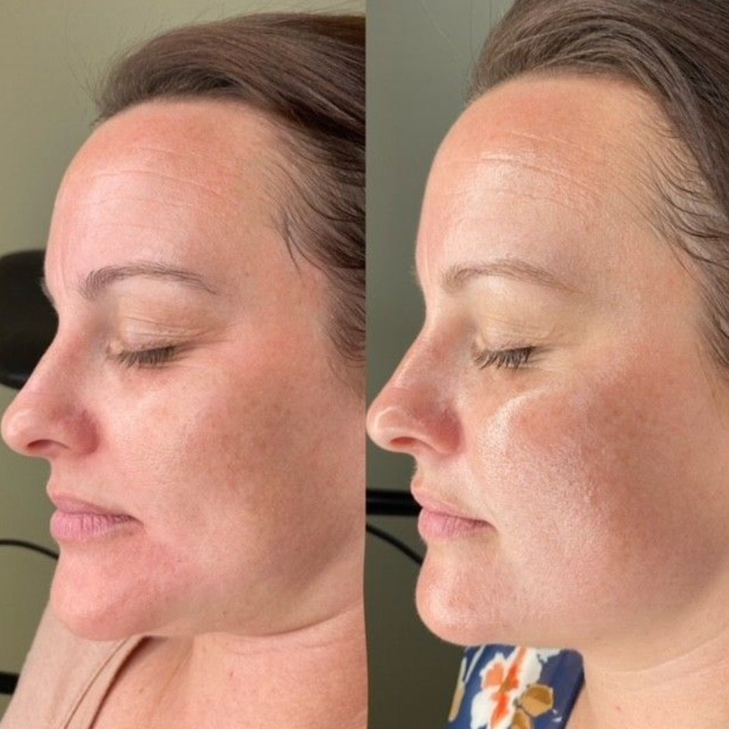 Chemical Peel skin treatment with Deep Cleanse