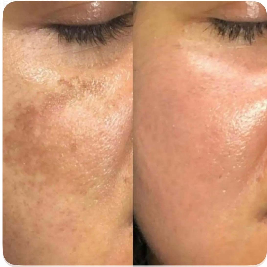 Pigmentation Lift(sunburn treatment)