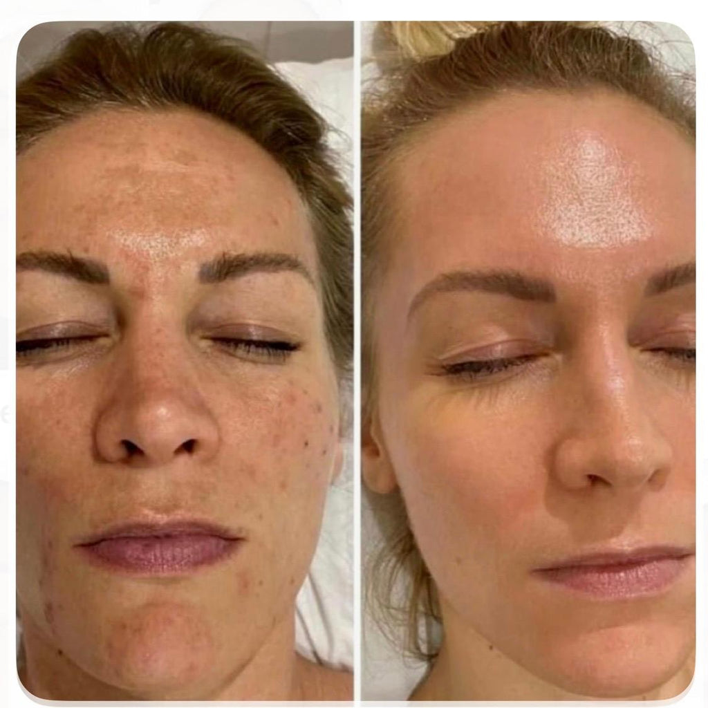 Whitening Lift Treatment