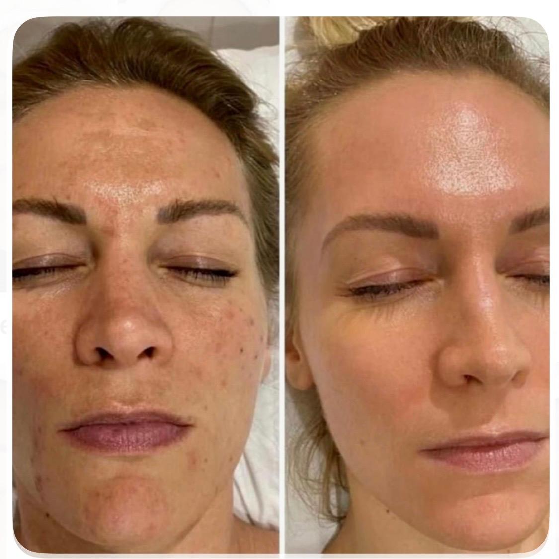 Whitening Lift Treatment