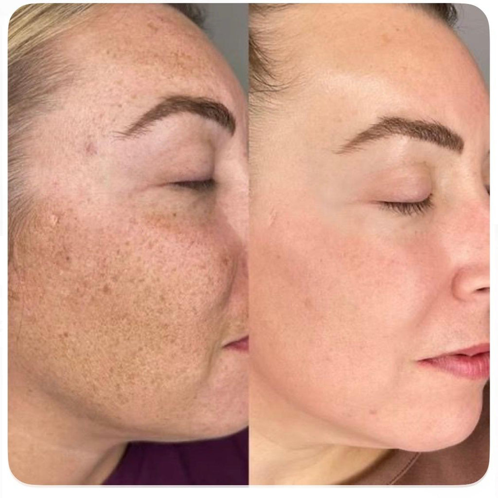 Pigmentation Lift(sunburn treatment)