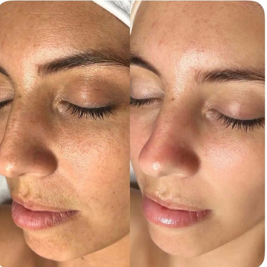 High Frequency Facial