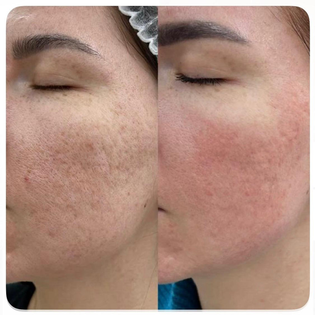 Pigmentation Lift(sunburn treatment)