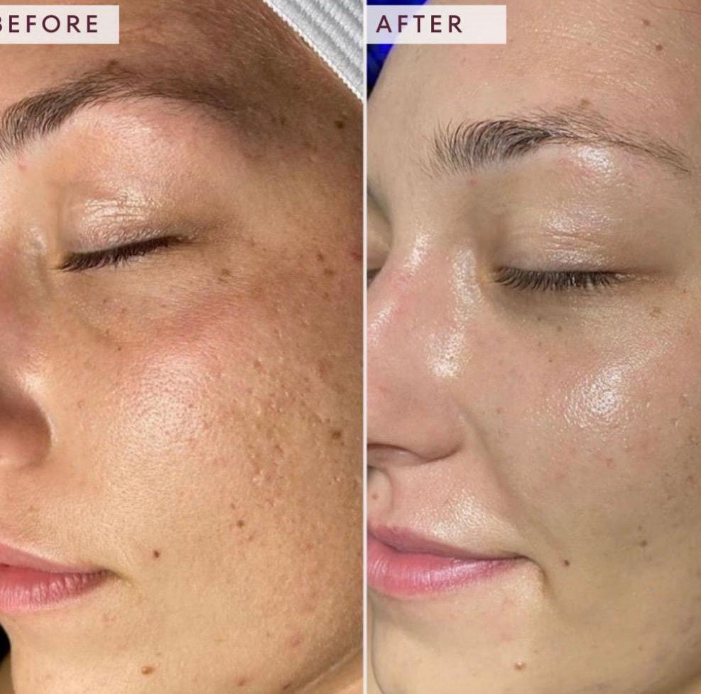 Whitening Lift Treatment