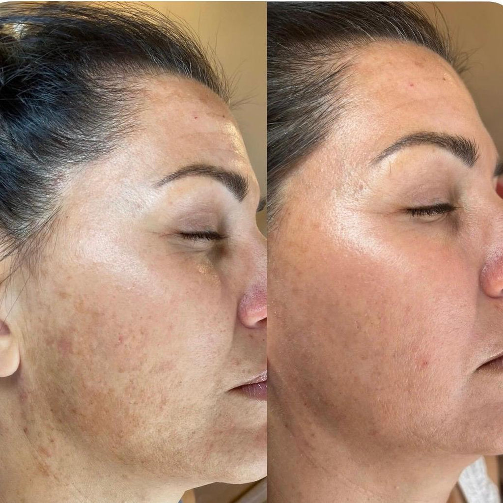 Pigmentation Lift(sunburn treatment)
